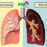 phổi tắc nghẽn mãn tính